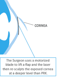 proceudres-lasik