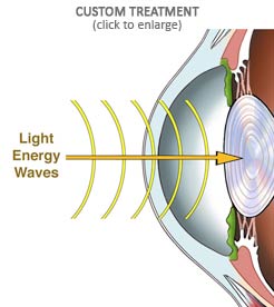 Custom Laser Vision Treatment